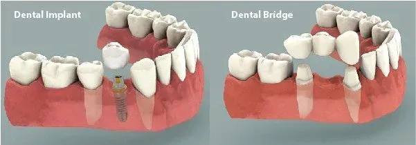 Dental Implant vs Dental Bridge 1
